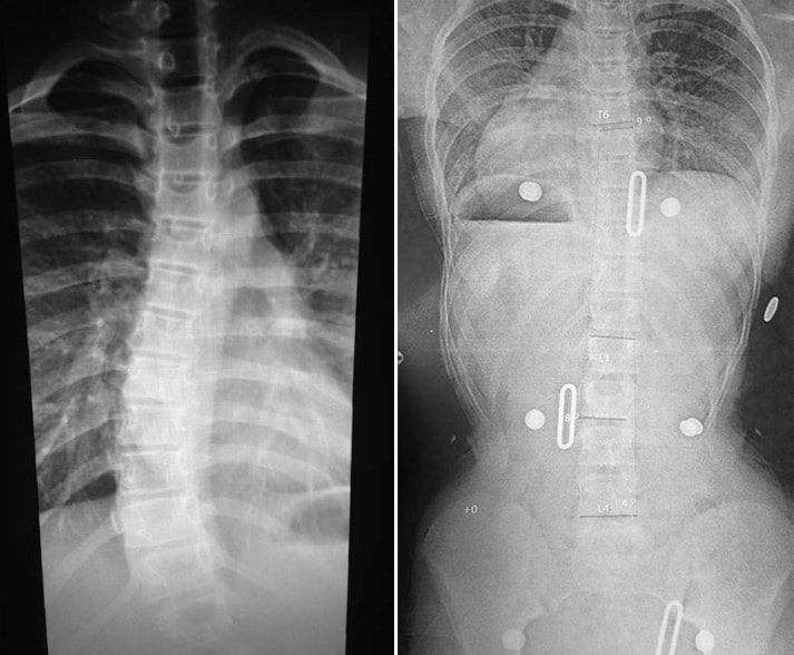 Esther's X-rays, before and after